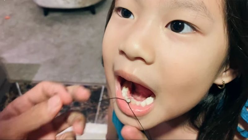 Khi nào cần nhổ răng sữa cho trẻ