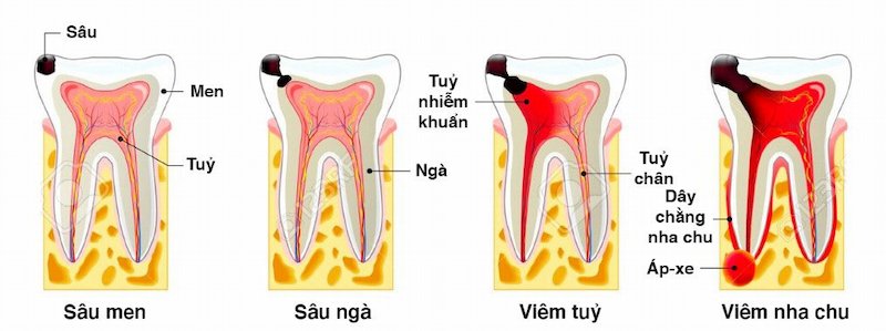 4 giai đoạn của quá trình sâu răng
