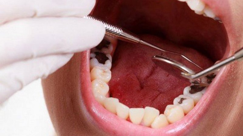 Nhổ răng là biện pháp điều trị cuối cùng nếu sâu răng đã ảnh hưởng đến tủy
