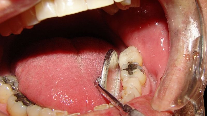 Răng sâu lồi thịt gây ra nhiều vấn đề về răng miệng khác