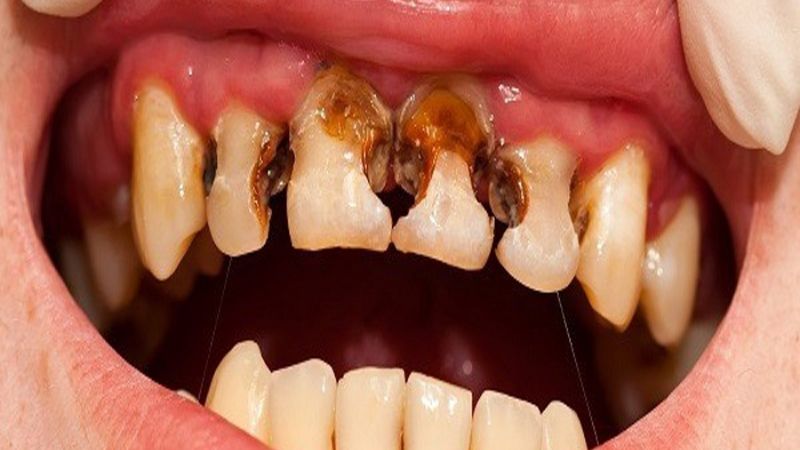 Sâu khe răng xảy ra do vệ sinh răng miệng kém và thói quen xấu