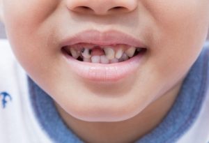 Sâu răng cửa ở trẻ em hay người lớn đều là hiện tượng rất phổ biến