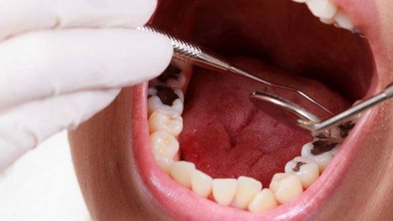 Nhổ răng sâu và trồng lại răng mới