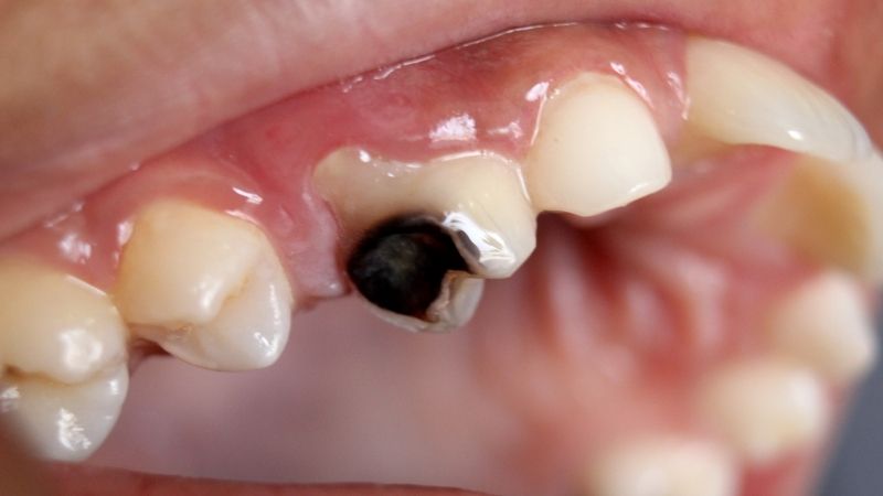 Vì sao sâu răng gây nổi hạch ở cổ