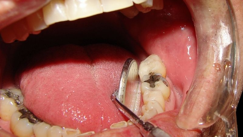 Người bệnh sâu răng nổi hạch nên điều trì thế nào