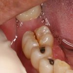 Dấu hiệu nhận biết đầu tiên là răng bắt đầu có đốm đen và xuất hiện những lỗ hổng trên bề mặt hoặc trong tủy răng