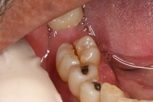 Dấu hiệu nhận biết đầu tiên là răng bắt đầu có đốm đen và xuất hiện những lỗ hổng trên bề mặt hoặc trong tủy răng