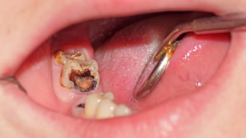 Biện pháp chữa trị cho sâu răng hàm số 6 tùy thuộc vào mức độ hiện tại nhẹ hay nặng