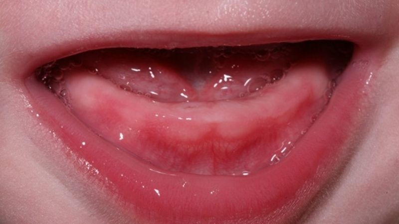 Dấu hiệu trẻ chậm mọc răng
