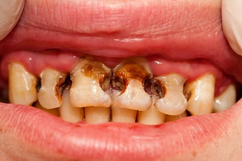 Trẻ bị sâu răng nếu không được điều trị rất nguy hiểm