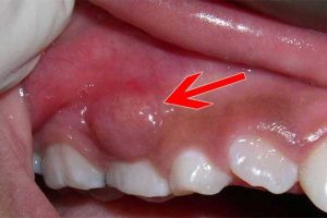 Áp xe nướu răng là bệnh lý gặp phải khá phổ biến hiện nay