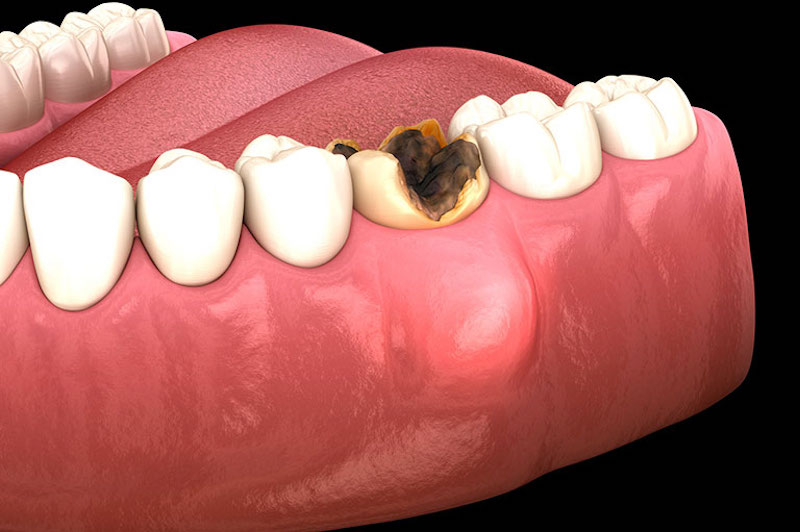 Áp xe răng có nguy hiểm không hiện đang là vấn đề được rất nhiều người bệnh quan tâm