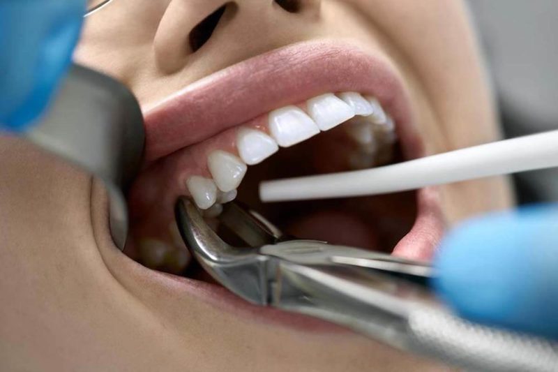 Nhổ bỏ răng là giải pháp cần thiết để điều trị áp xe răng nghiêm trọng