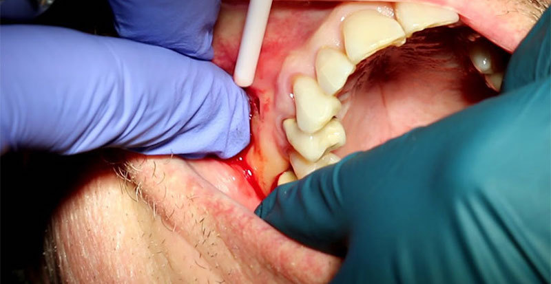 Áp xe răng số 7 nghiêm trọng cần phải điều trị tủy, rạch ổ áp xe xử lý viêm