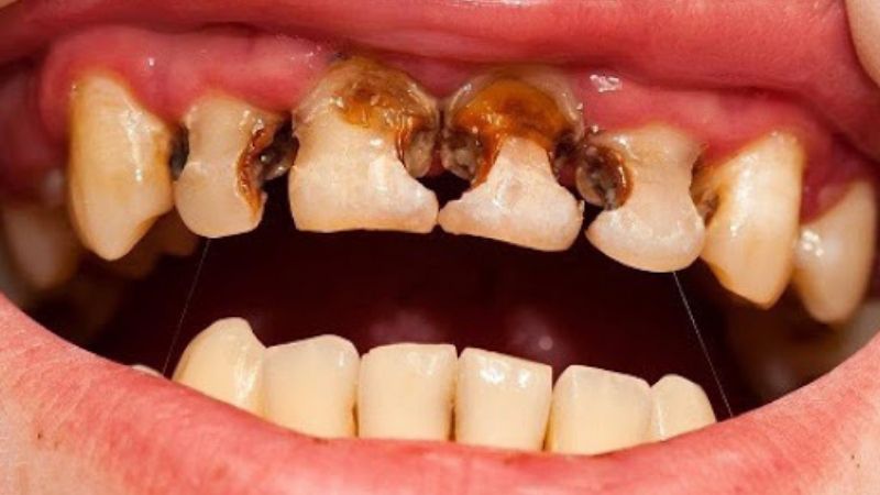 Yếu tố di truyền cũng có thể làm bé 2 tuổi bị sâu răng