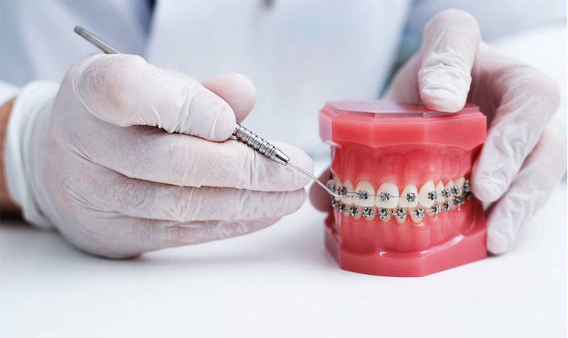 Niềng răng mắc cài kim loại là biện pháp được lựa chọn nhiều nhất hiện nay bởi tính hiệu quả và chi phí tiết kiệm