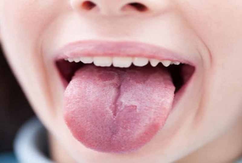 Nấm lưỡi bản đồ không gây nguy hiểm trực tiếp đến sức khỏe người bệnh