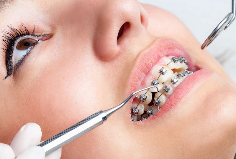 Cần thăm khám nha khoa thường xuyên để tránh gặp phải sự cố nuốt dây cung khi niềng răng