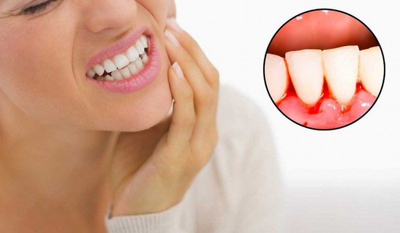 Một số trường hợp gặp phải tình trạng hôi miệng kèm triệu chứng chảy máu ở chân răng