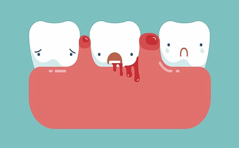 Răng bị mất can xi là một trong những tác hại của niềng răng nếu bạn không biết cách chăm sóc răng tốt