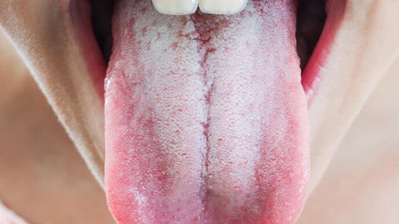 Người lớn cũng có nguy cơ mắc bệnh nấm miệng cao