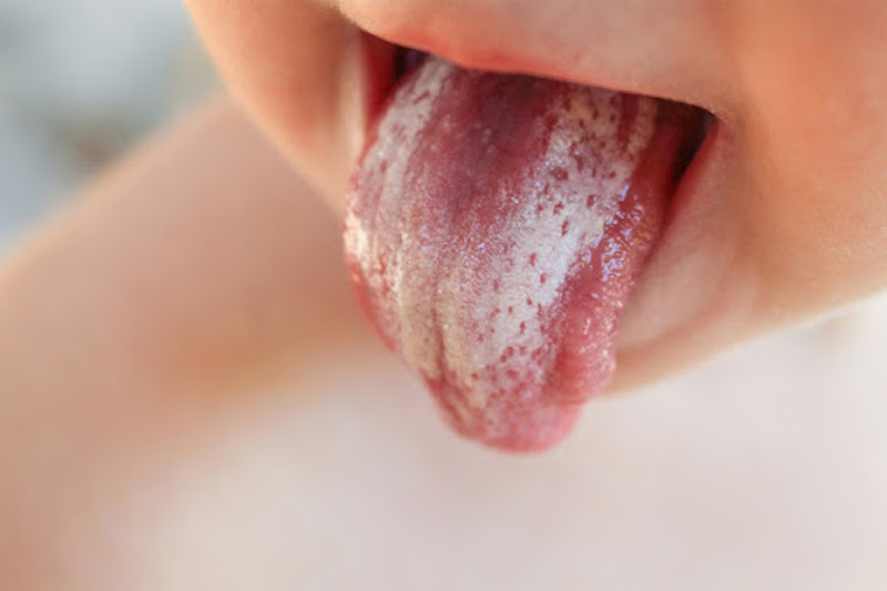 Nấm miệng (tưa lưỡi) thường dễ gặp ở trẻ nhỏ hiện nay