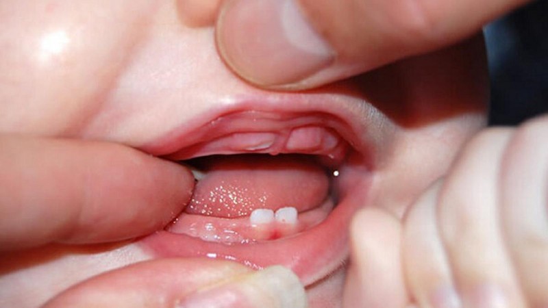 Răng trẻ mọc chậm nên đưa đến cơ sở y tế thăm khám và xử lý kịp thời