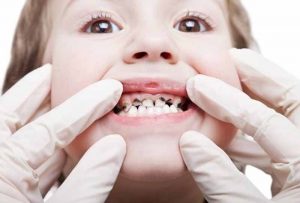 Khi còn sót chân răng sữa sau khi nhổ ba mẹ cần đưa trẻ đến gặp bác sĩ để được xử lý an toàn