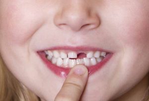 Răng sữa ở trẻ là hàm răng tạm thời