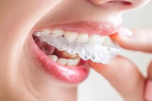 Niềng răng Invisalign áp dụng từ 1 - 2 năm mới có hiệu quả