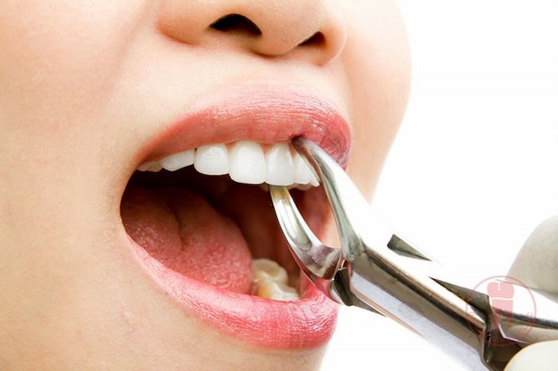 Tùy vào từng trường hợp bác sĩ sẽ tiến hành nhổ răng trước khi niềng