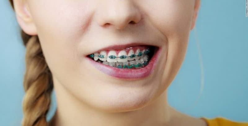 Tác hại của niềng răng: Răng yếu và dễ rụng sớm