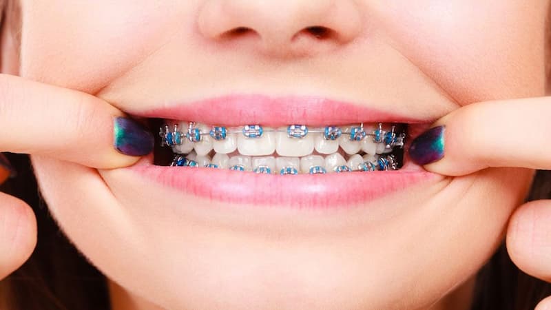 Niềng răng mắc cài thường sử dụng dây thun để cố định dây cung trong mắc cài