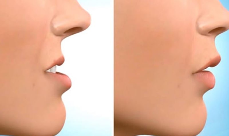 Hình ảnh khuôn hàm trước và sau khi thực hiện chỉnh nha niềng răng