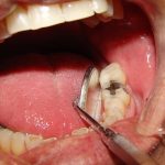 Sâu răng là bệnh lý dễ mắc phải ở bất kỳ độ tuổi nào