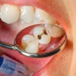 Sâu răng dẫn đến ung thư