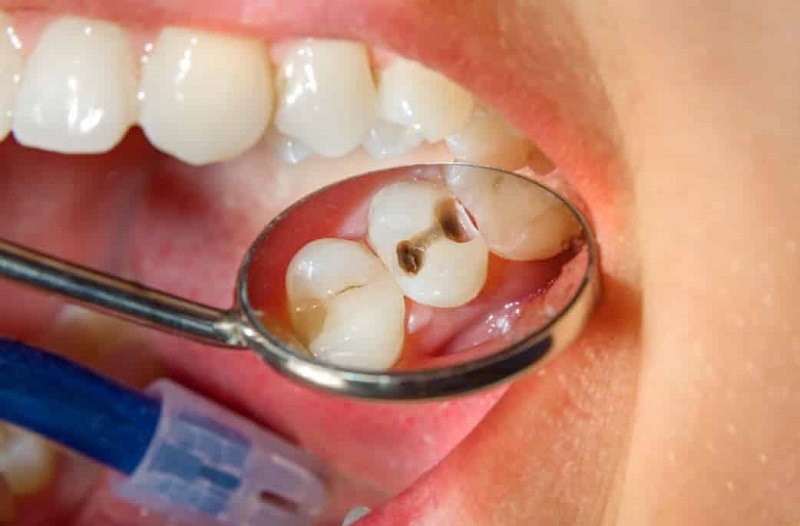 Sâu răng có thể dẫn đến ung thư