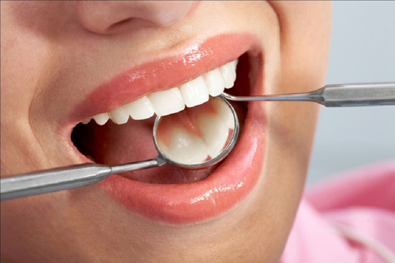 Trám răng (hàn răng) cũng được đánh giá là một giải pháp an toàn