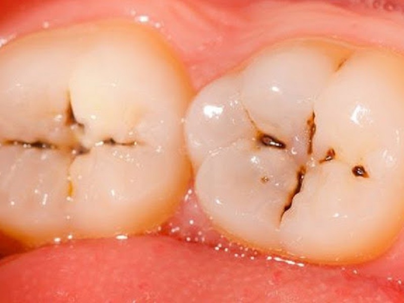 Tái khoáng là giải pháp phổ biến thường được áp dụng cho trường hợp răng sâu nhẹ