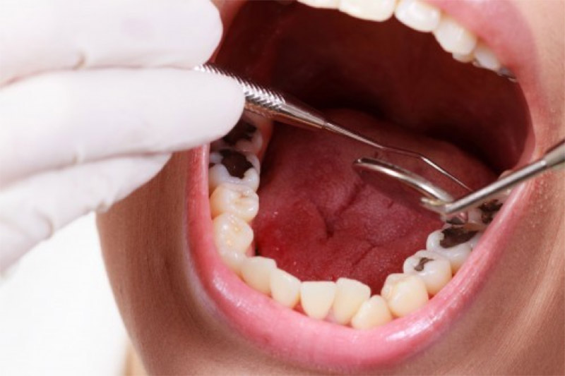 Sâu răng nhẹ là được xem là một trong những vấn đề sức khỏe phổ biến nhất hiện nay