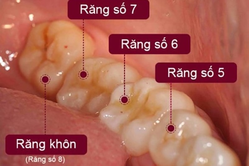 Sâu răng số 5 rất dễ xảy ra do vị trí đặc thù của nó trên hệ thống cung hàm