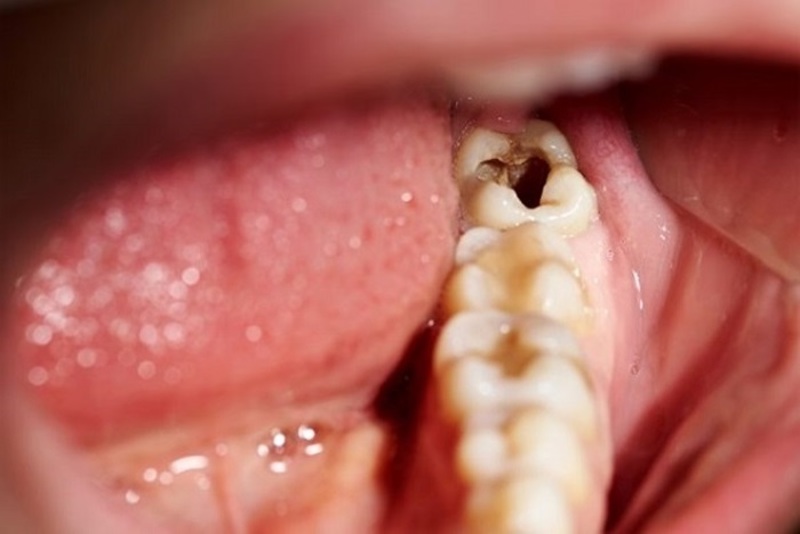 Răng số 7 dễ bị sâu hơn các răng khác do vị trí đặc biệt trên cung hàm