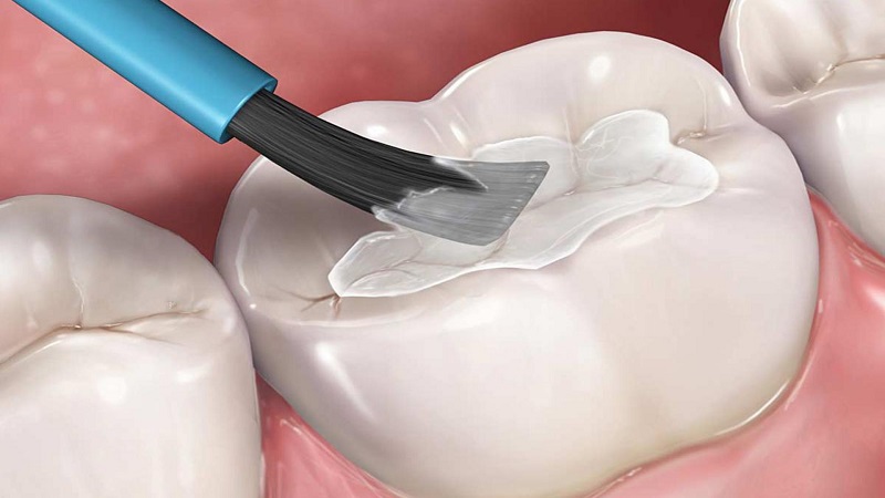 Răng bị bào mòn cũng được sẽ áp dụng hình thức điều trị này