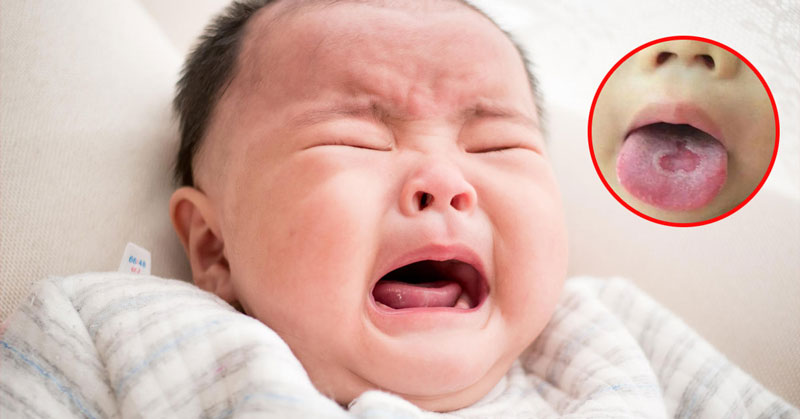 Tưa lưỡi là tình trạng phổ biến dễ bắt gặp nhất ở trẻ sơ sinh và trẻ nhỏ