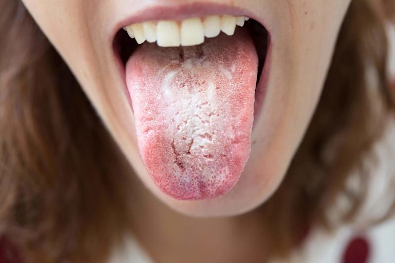 Tưa lưỡi ở bà bầu rất dễ nhận biết với những mảng trắng và vết nứt tại bề mặt lưỡi