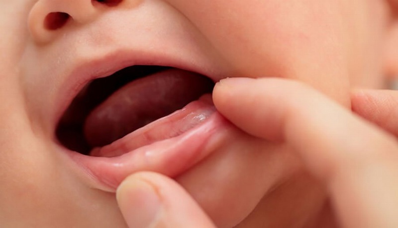 Có rất nhiều nguyên nhân dẫn đến tình trạng vì sao trẻ chậm mọc răng