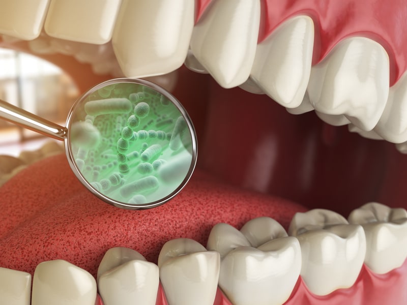 Vệ sinh khoang miệng không sạch làm vi khuẩn phát triển gây viêm nhiễm