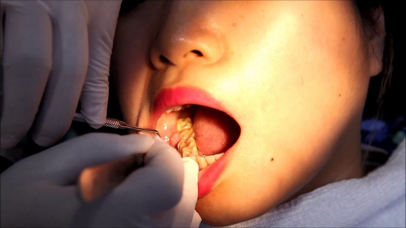 Bác sĩ có thể cắt loại trùm để răng số 8 mọc đúng vị trí