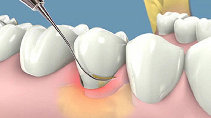Lấy cao răng giúp loại bỏ vi khuẩn gây viêm nướu răng 