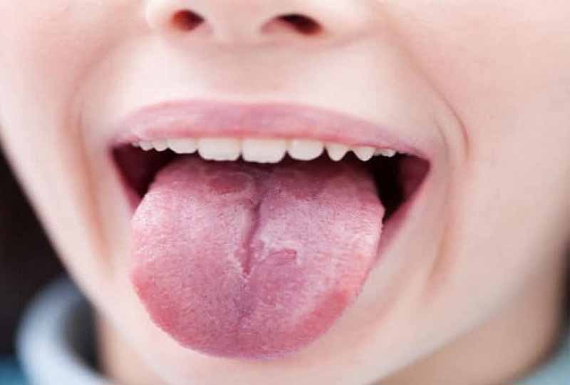 Nấm lưỡi bản đồ là bệnh lý thường gặp ở cả trẻ nhỏ và người trưởng thành